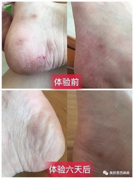 RootSense根元智能鞋柜-Footies-有效缓解脚气对比图